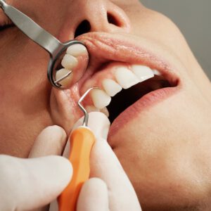 Professionelle Zahnreinigung