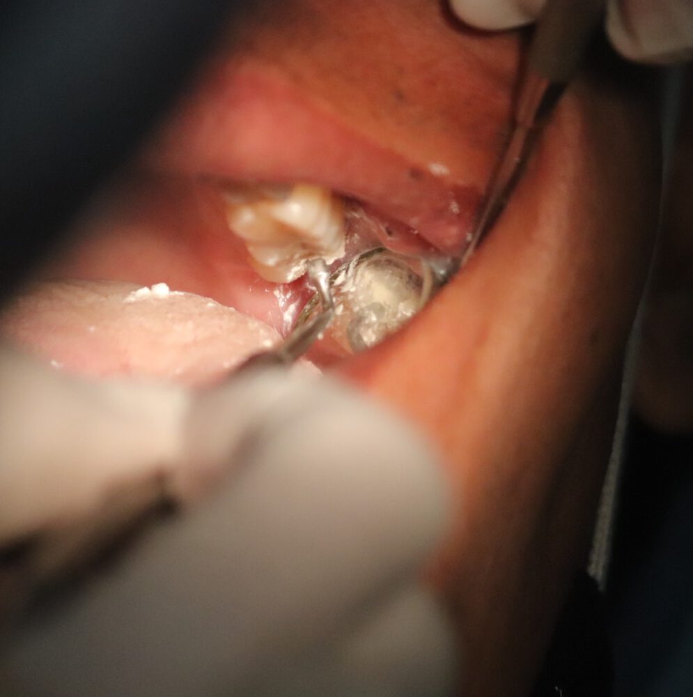 Untersuchung der Zähne zum Beispiel nach Zahnstein